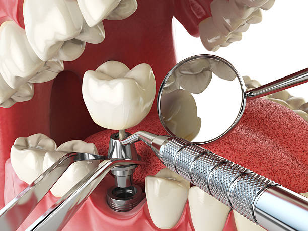 Best Urgent Care for Lost Fillings or Crowns in Crooked River Ranch, OR